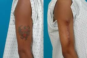 Surgical Excision and Reconstruction of Tattoo Following Hypersensitivity